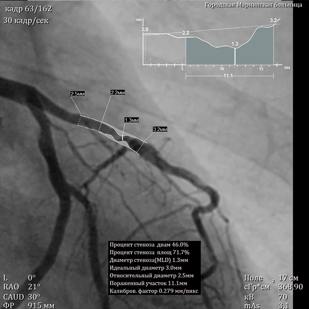 Interventional Procedure