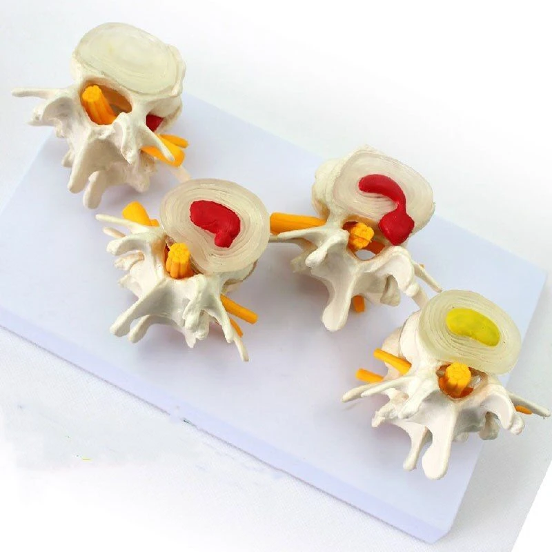 Model of vertebral pathologies, 11208