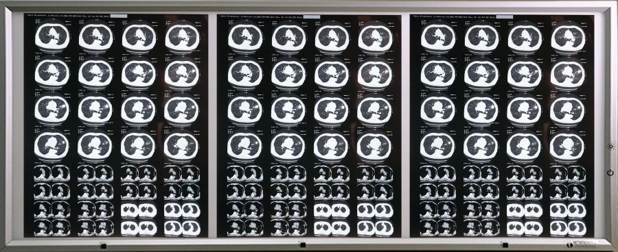 Medical Negatoscope according to TU 9452-001-11349579-2016 in variant version: Three-frame Negatoscope with accessories