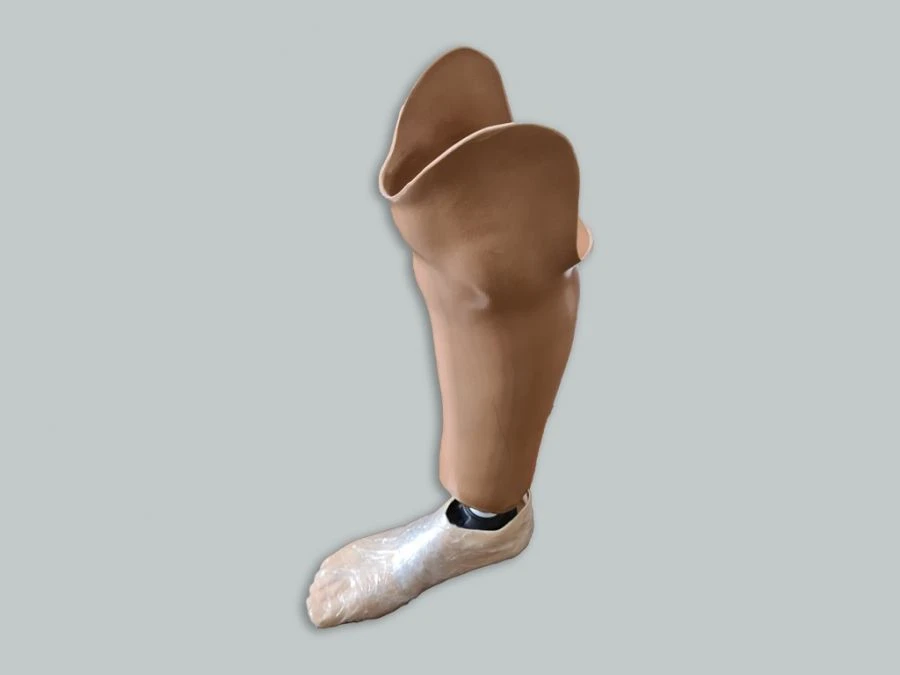 Modular tibial prosthesis, including those with underdevelopment