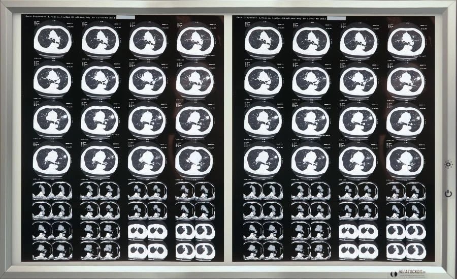 Medical Negatoscope according to TU 9452-001-11349579-2016 in variant version: Two-frame Negatoscope with accessories