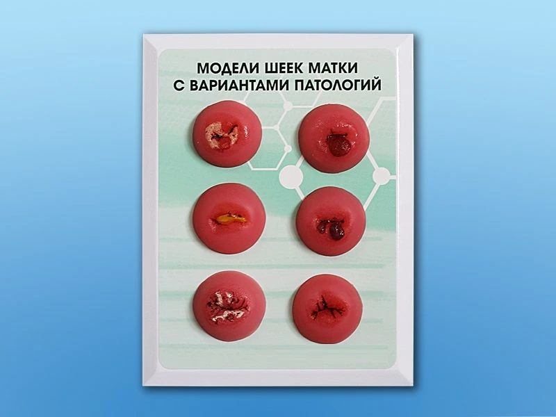 Cervical lesion model GP6611