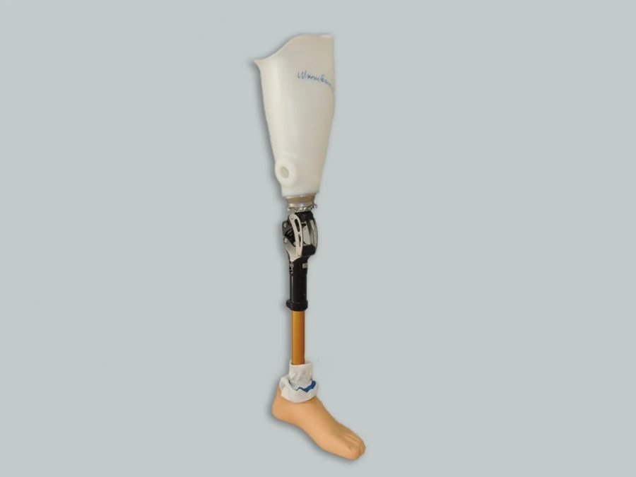 Modular prosthesis for hip dislocation