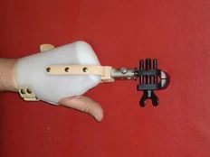 Working prosthesis of the hand, including in case of disarticulation and partial disarticulation of the hand