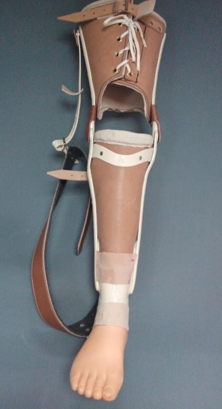 Non-modular tibial prosthesis, including congenital underdevelopment, PH3-H.1