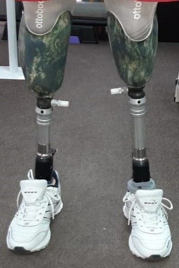 Modular tibial prosthesis, including those with underdevelopment