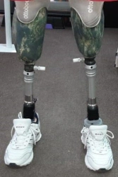 Modular tibial prosthesis, including those with underdevelopment