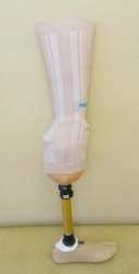 Modular tibia prosthesis, including congenital underdevelopment