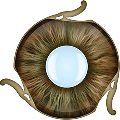Irido-intraocular polymer disc-shaped optically haptic monolithic lens for treatment of combined pathology of iris and chr