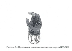 Hand prosthesis with external source of energy, including separation and partial separation of the hand PR0-VEE