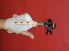 Working hand prosthesis, including partial and partial dislocation of the hand PC9-70-P; 20810:Working hand prosthesis, includin