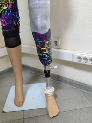 Modular tibial prosthesis, including for congenital malformations