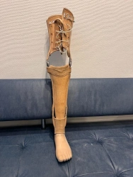 Non-modular tibial prosthesis, including for congenital underdevelopment