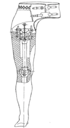 Non-modular hip replacement, PN-HFB