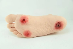 Diabetic foot soft model, ROST-S19