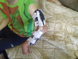 Elbow orthopaedic devices