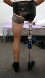 Modular prosthesis for hip dislocation