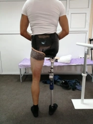 Modular prosthesis for hip dislocation