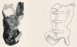 Functional-corrective corset for the thoracolumbar spine of the Chenault type KR4Sh