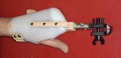 Working hand prosthesis, including underdevelopment