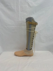 Non-modular tibial prosthesis, including for congenital malformations