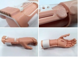 Active (traction) prosthesis of the hand, including partial dislocation and partial dislocation of the hand PR0-T-OK