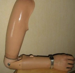 Prosthesis after shoulder dislocation functional-cosmetic