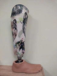 Modular tibial prosthesis, including those with underdevelopment