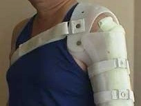 Orthopaedic devices for the shoulder joint
