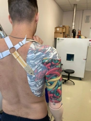 Prosthesis after shoulder dislocation with microprocessor control PR8-MBO