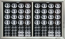 Medical Negatoscope according to TU 9452-001-11349579-2016 in variant version: Two-frame Negatoscope with accessories