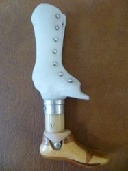 Prostheses for congenital underdevelopment of lower limbs