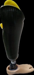 Modular tibia prosthesis, including congenital underdevelopment