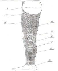 Modular prosthesis for hip dislocation