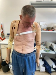 Shoulder prosthesis with microprocessor control PR4-MBO