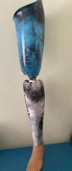 Modular hip prosthesis, including for congenital underdevelopment