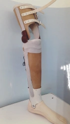 Non-modular tibial prosthesis, including congenital underdevelopment PN3-H.1