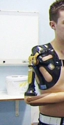 Prosthesis after shoulder dislocation with electromechanical drive and contact control system