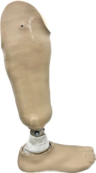 Modular tibia prosthesis, including underdevelopment, PN3-92
