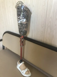 Modular hip prosthesis, including for congenital underdevelopment