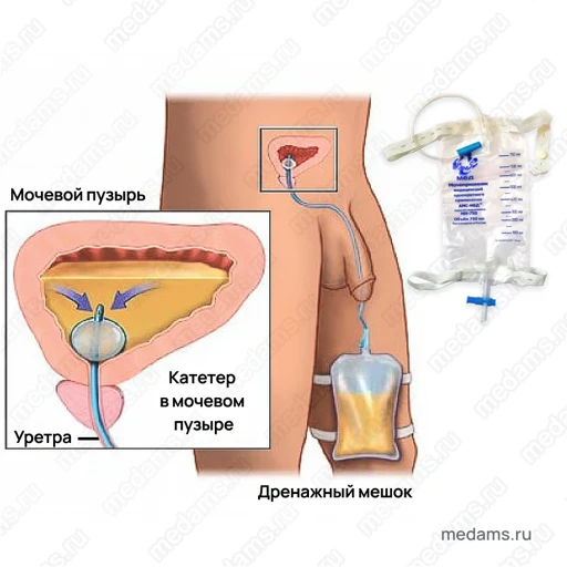 Disposable Medical Urine Collector MN500 for Catheter Use