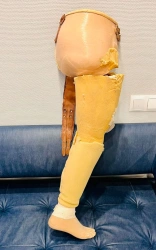 Modular prosthesis for hip dislocation