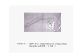 Prosthesis after shoulder dislocation with electromechanical actuator and contact control system PR8-VIE-01