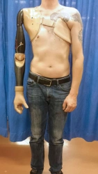 Prosthesis after shoulder dislocation with electromechanical drive and contact control system