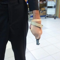 Working hand prosthesis