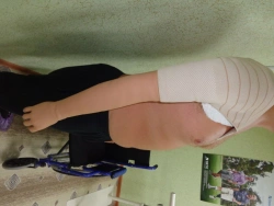 Prosthesis after shoulder dislocation cosmetic PR8-KOB