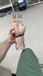 Active (traction) prosthesis of the hand, including for separation and partial separation of the hand