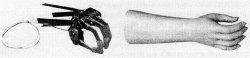 Active prosthesis of the hand, including partial dislocation and partial dislocation of the hand PR0-22-1