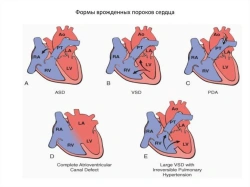 Congenital heart defects model, 16016