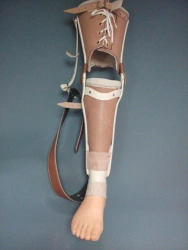 Non-modular tibial prosthesis, including for congenital malformations
